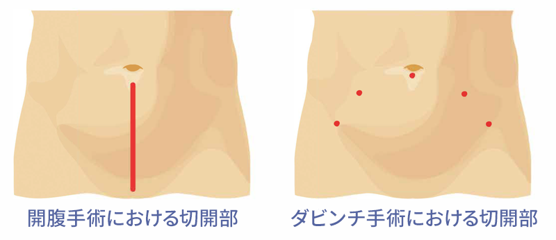 それぞれの手術による切開部