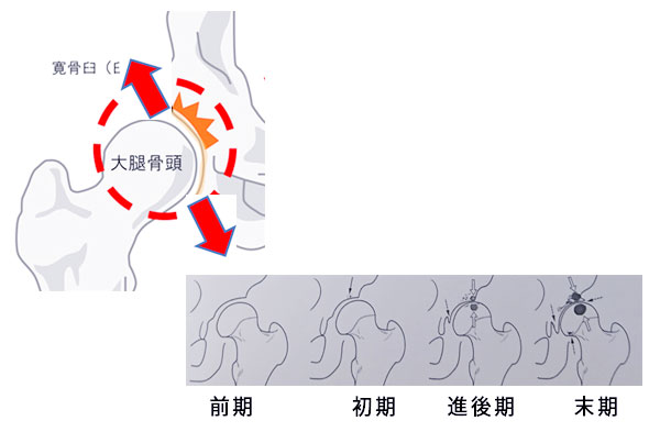 二次性変形性股関節症