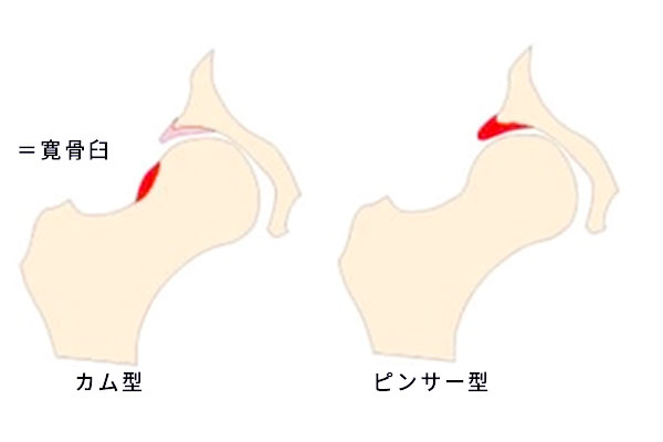 多血小板血漿 Prp による治療外来について Prp Aps治療 股関節 整形外科 診療科 センター 部門 順天堂大学医学部附属静岡病院