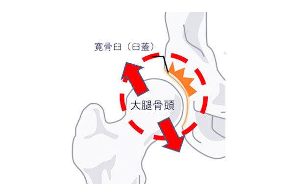 寛骨臼形成不全